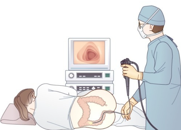 대장암 원인 예방 내시경