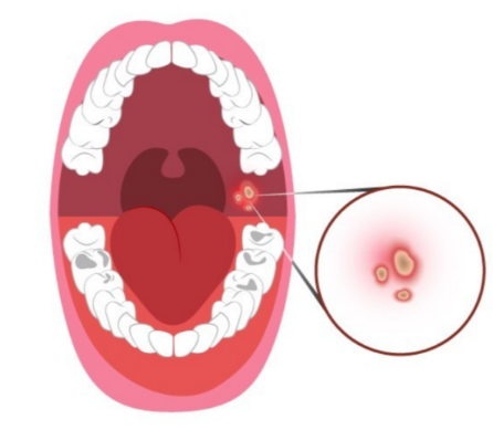 설암의 단계별 생존률