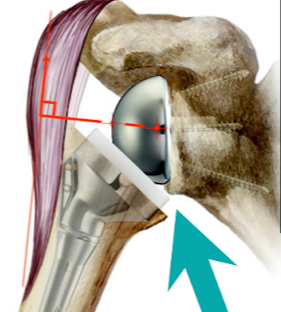 어깨의 인공관절