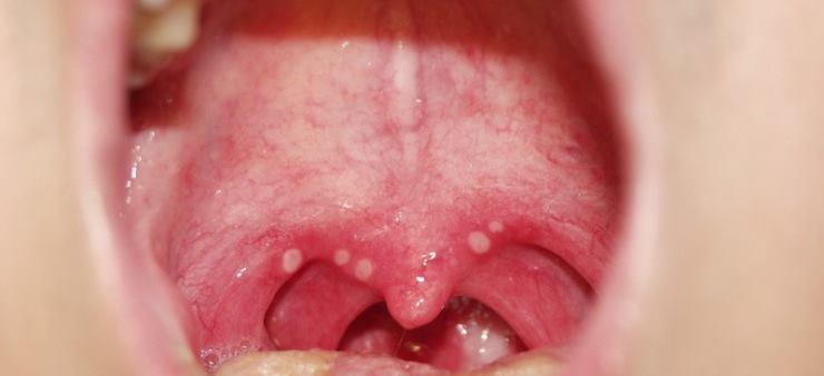 구내염이 생긴 목젖
