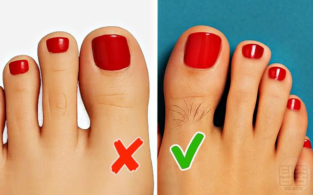 발이 보내는 위험한 신호 발가락 털 사라짐 말초동맥질환