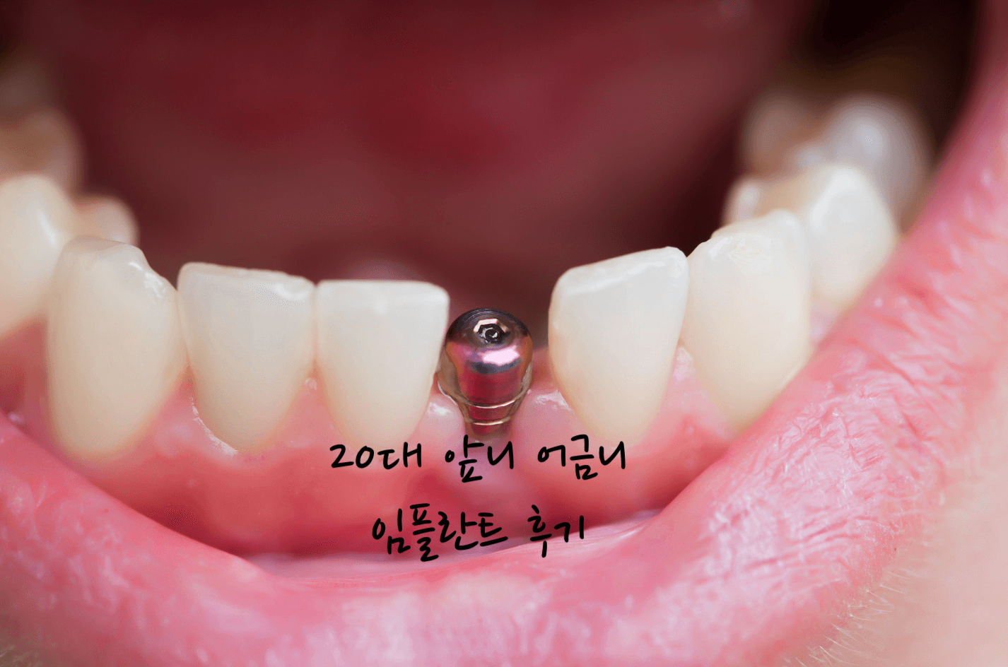 20대 임플란트