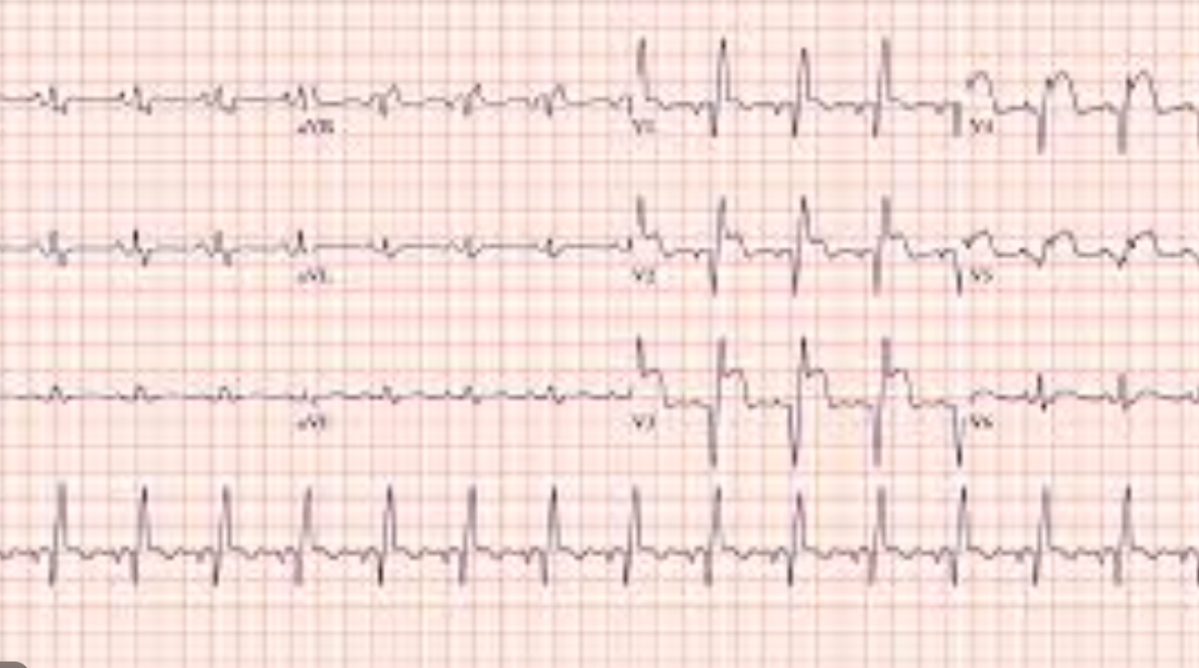 관상동맥질환과 급성 심근경색
