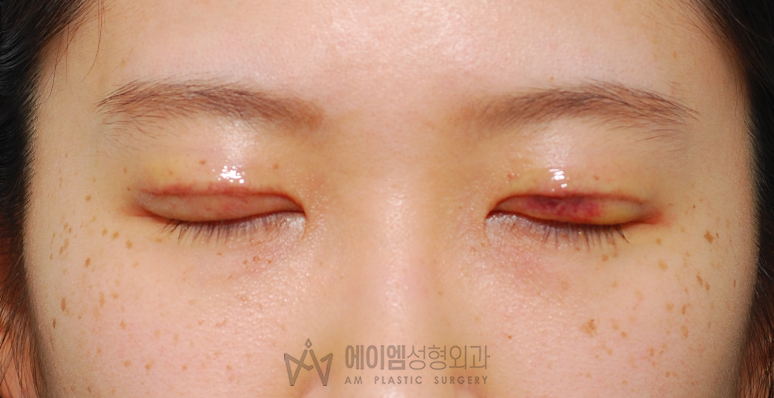 소세지눈 두줄따기 7일 눈감은사진