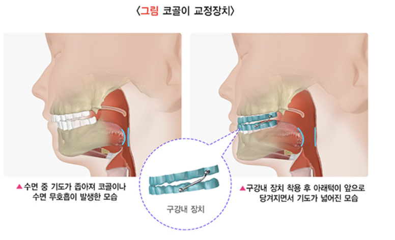 코골이 교정장치
