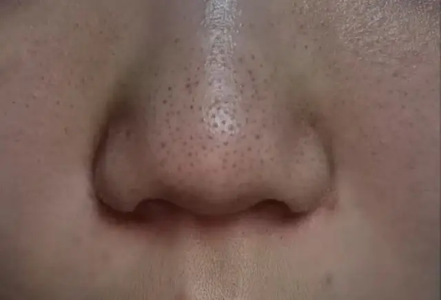 소극성 속모증의 관리 방법
