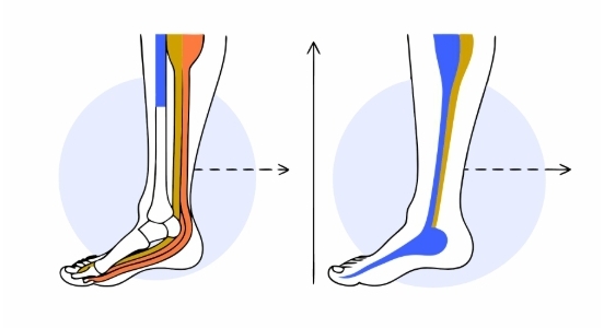 족저근막염 수술 과정