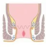 치질-증상-자가치료법-건강