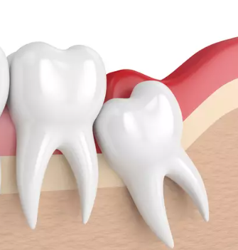 사랑니 발치후 식사 메뉴 시간별 추천 커피 술 담배 라면 언제 총정리