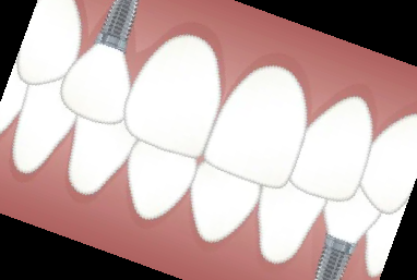 임플란트 가격 종류 비용