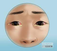 포도막염