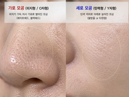 피지형 가로 모공과 탄력 저하 세로 모공 특징 비교 분석 자가 진단 사진
