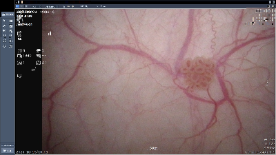 방광암 내시경 사진