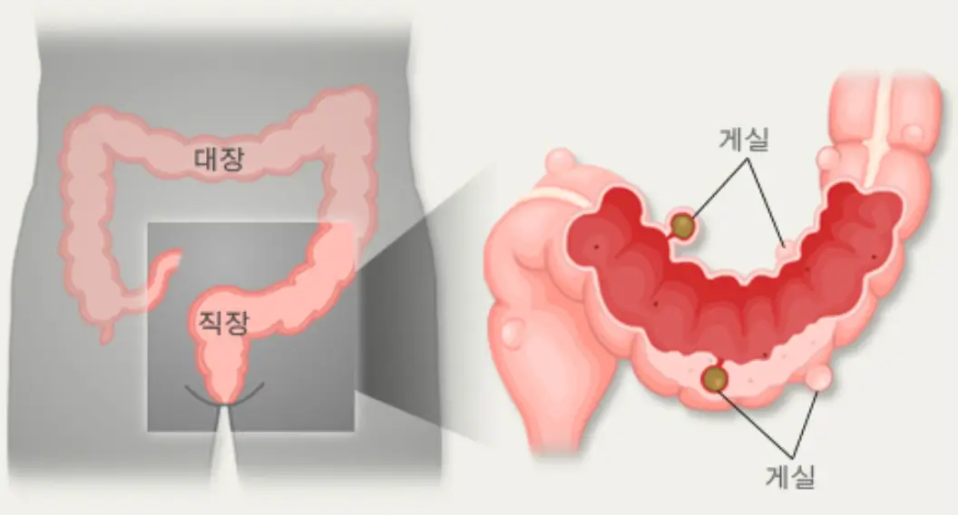 게실염