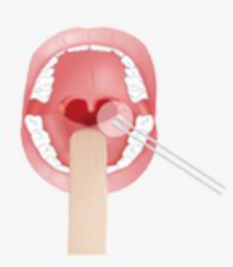 마이코플라즈마 폐렴 원인, 증상, 항생제 치료