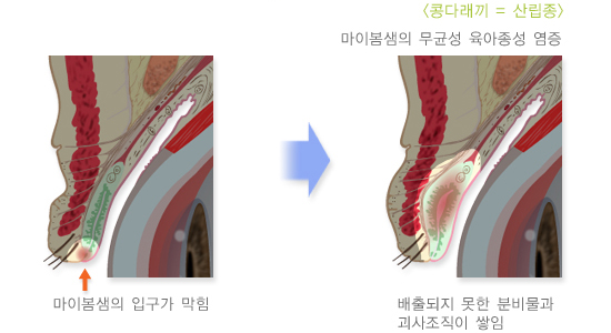 콩다래끼1