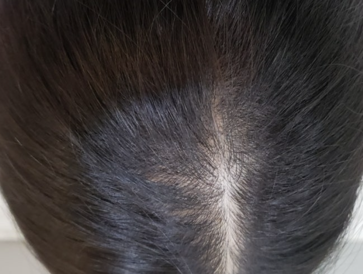 모발이식 3000모 비용 4000모 비용 부작용 과정