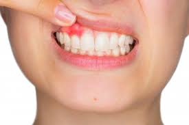 잇몸이 붓고 아플 때