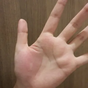 모기 물려 가려울 때 땀띠에 안티푸라민 연고 효능 부작용 사용후기_14