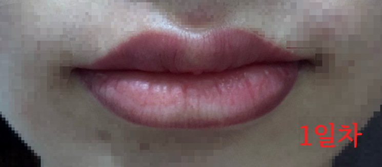 립타투 중화 시술 당일 입술 상태 사진 &ndash; 붓기와 진한 컬러