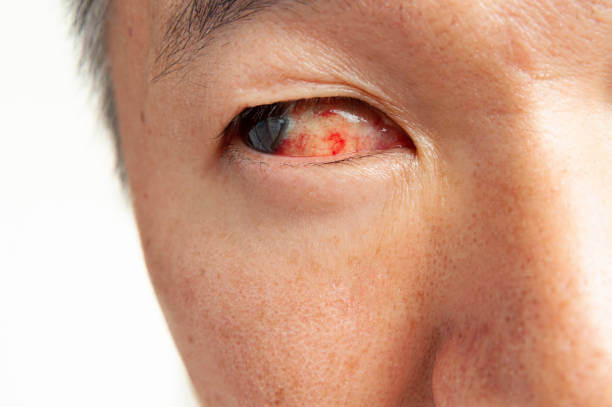 눈 실핏줄 터짐 원인 9가지 및 치료방법. 눈 실핏줄 터짐, 눈의 조직과 혈관의 손상으로 인해 발생하는 현상으로, 여러 요인에 의해 유발될 수 있습니다. 이 문제는 안구 건강을 반영하며, 원인을 파악하고 적절한 치료 및 예방책을 찾는 것이 중요합니다.