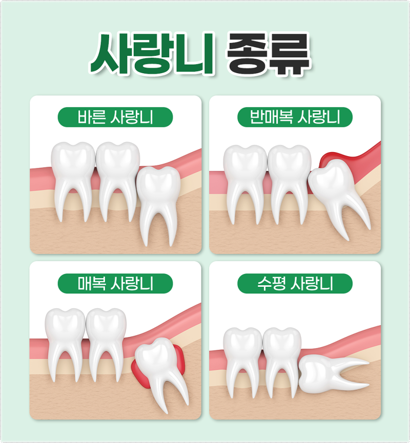 사랑니의 종류