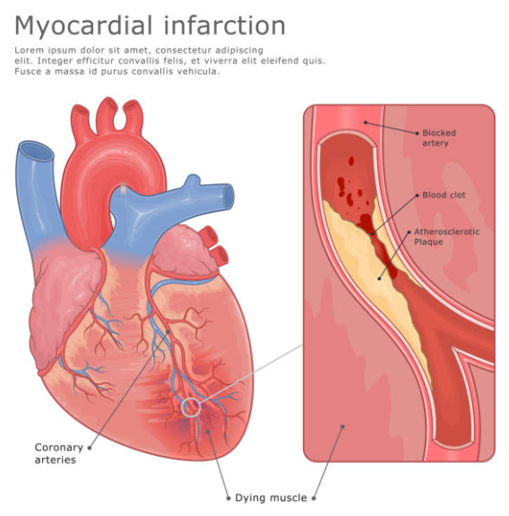 심부전과 관련된 사진2