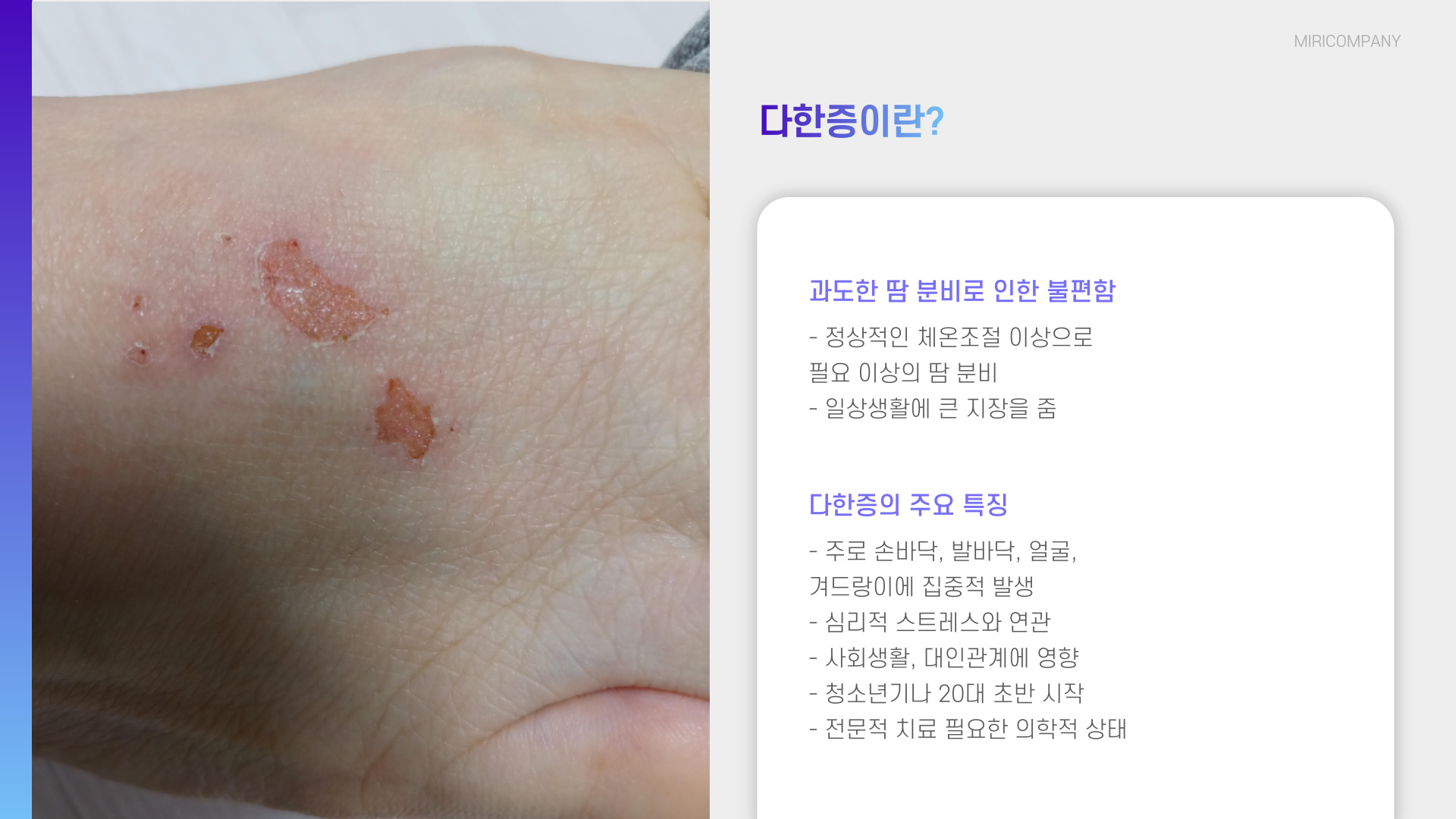 다한증과 항콜린제의 원인