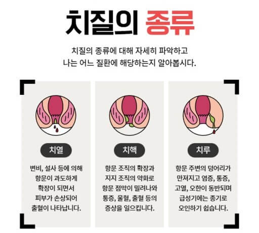 치질의 종류와 구분