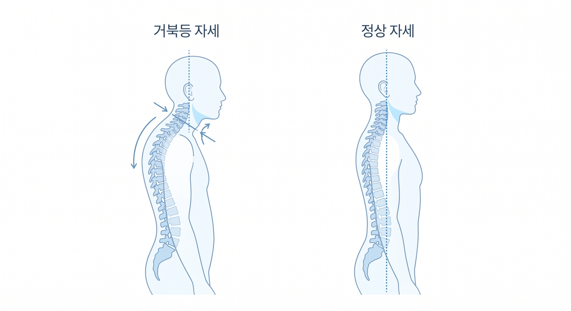 컴퓨터·스마트폰으로 굳어진 거북등 집에서 교정하는 운동 7가지