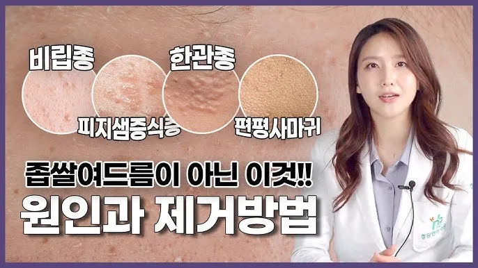 비립종 생기는 이유 비립종 없애는 방법 피부 관리법_1