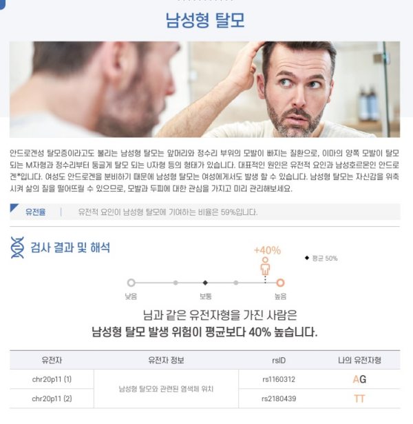 남성형 탈모