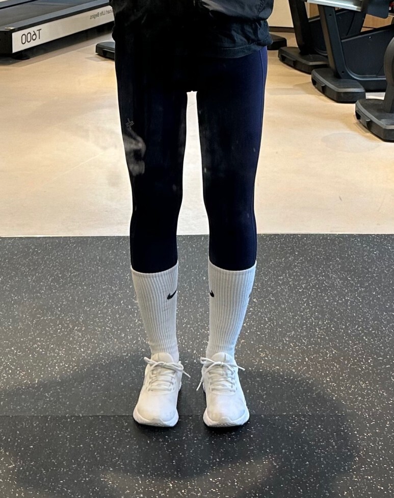 허벅지 지방흡입 후기