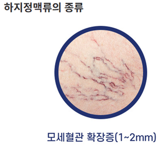 하지정맥류-다리가-붓는-이유