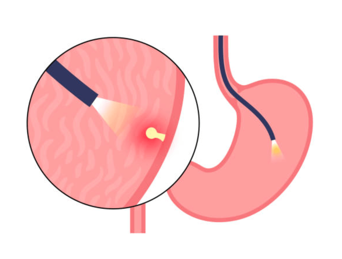 위 용종 제거 보험