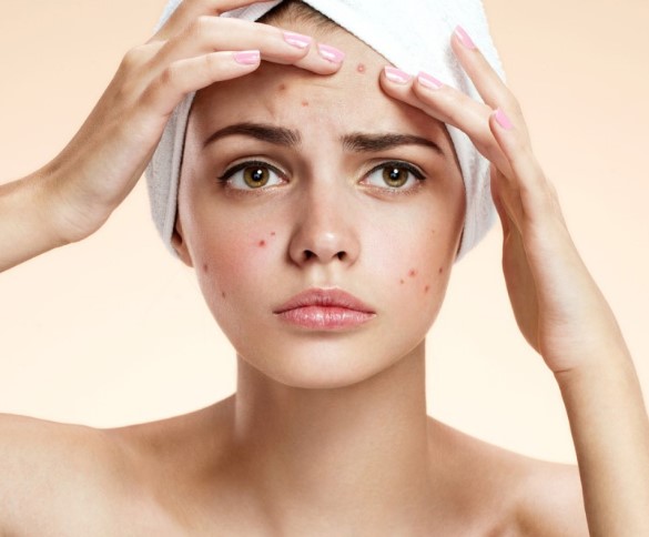 여드름 원인 및 종류