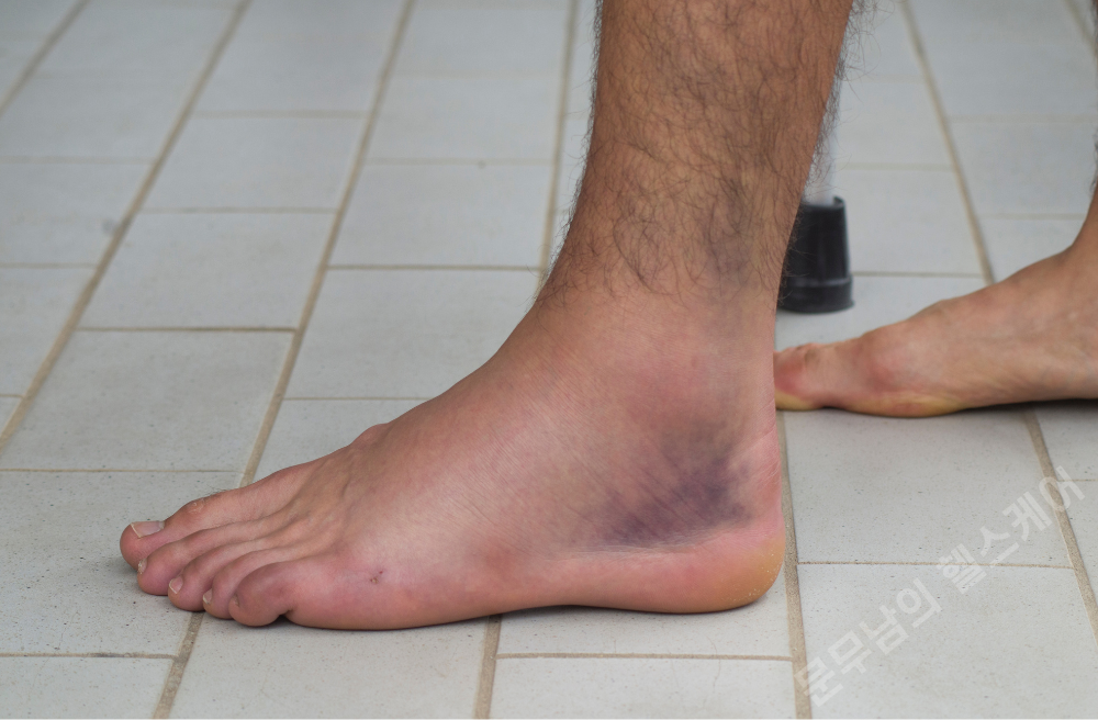 바깥쪽 발목 통증 원인