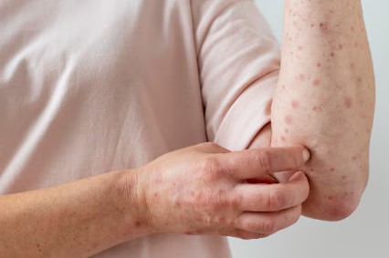 대상포진 초기증상과 원인 그리고 치료와 예방법까지