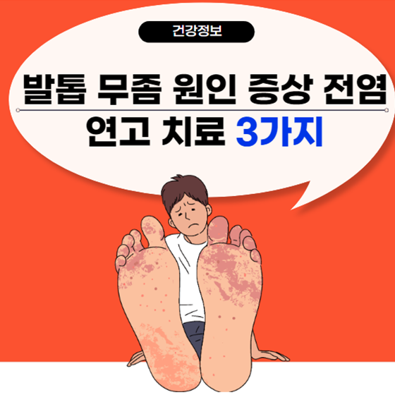 발톱 무좀 원인 증상 전염 연고 치료 3가지