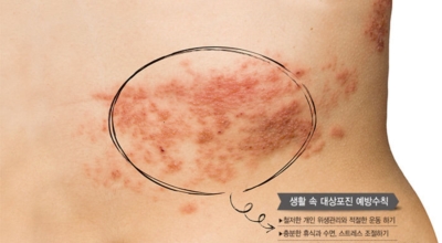 대상포진이미지