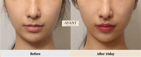 인중 축소 수술