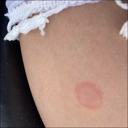 발적이 생긴 팔