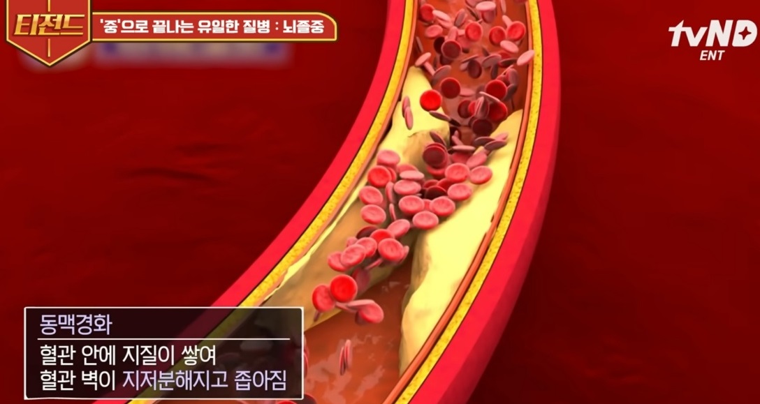 뇌졸중-원인-동맥경화