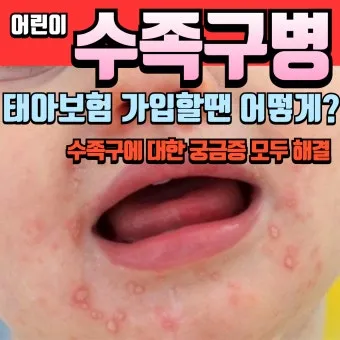 수족구 초기 증상 어른 감염 격리기간 예방 치료 완전 가이드_19
