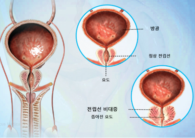 전립선-비대증