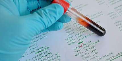 후천성 면역 결핍증