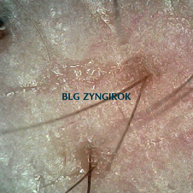 탈모 극복 프로젝트 - 오른쪽 M자 부위 두피 모습이다.