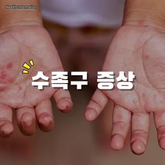 수족구 초기 증상 어른 감염 격리기간 예방 치료 완전 가이드_13