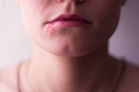 대상포진 증상, 전염, 치료방법 총정리 (2024ver)