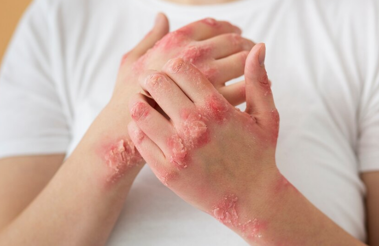 대상포진 후 신경통